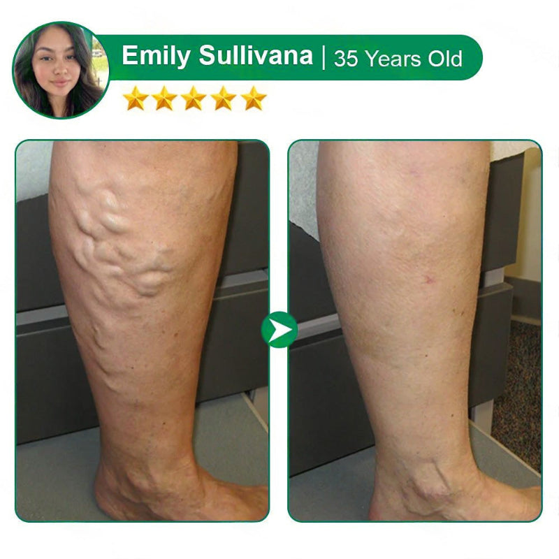 Varicose Vein Relief Microneedle Patch