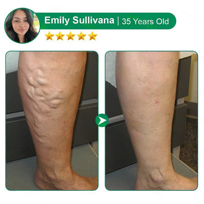 Varicose Vein Relief Microneedle Patch