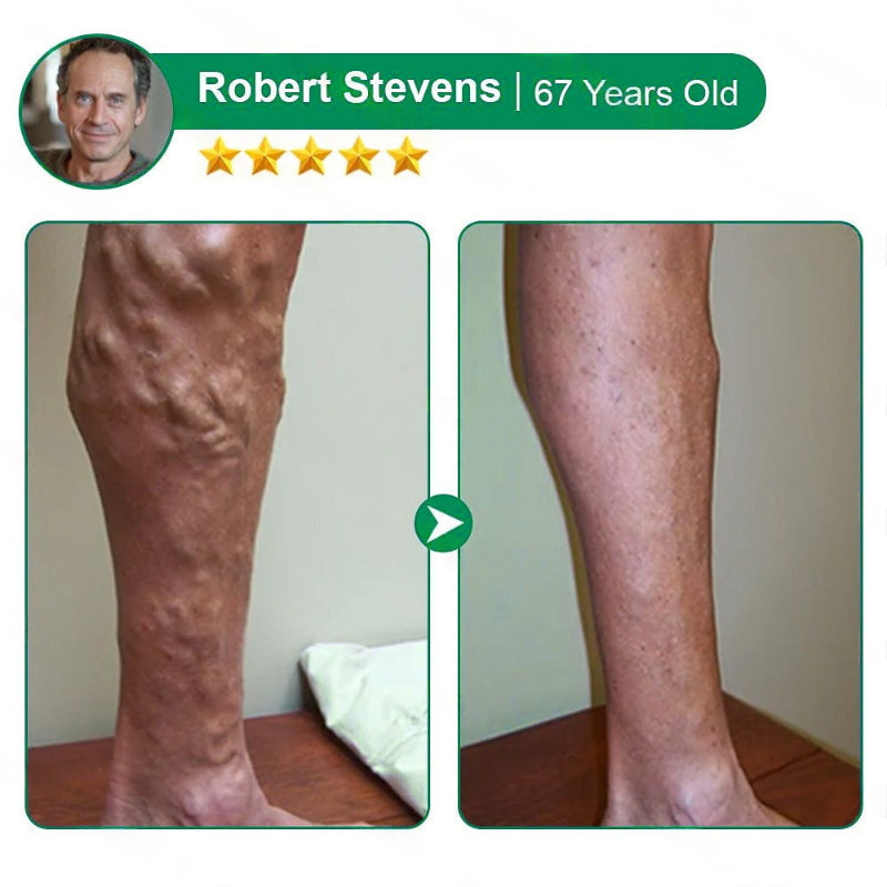 Varicose Vein Relief Microneedle Patch