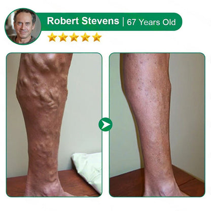 Varicose Vein Relief Microneedle Patch