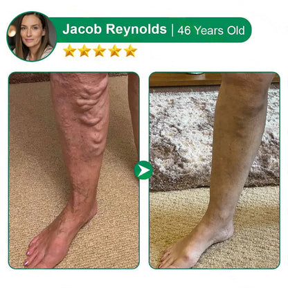 Varicose Vein Relief Microneedle Patch