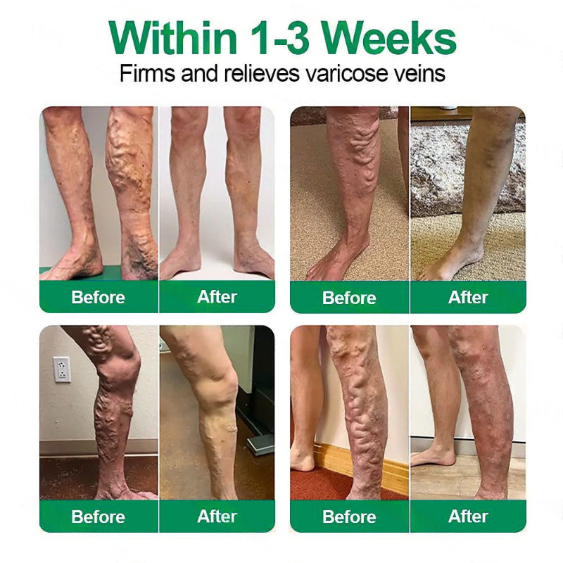 Varicose Vein Relief Microneedle Patch
