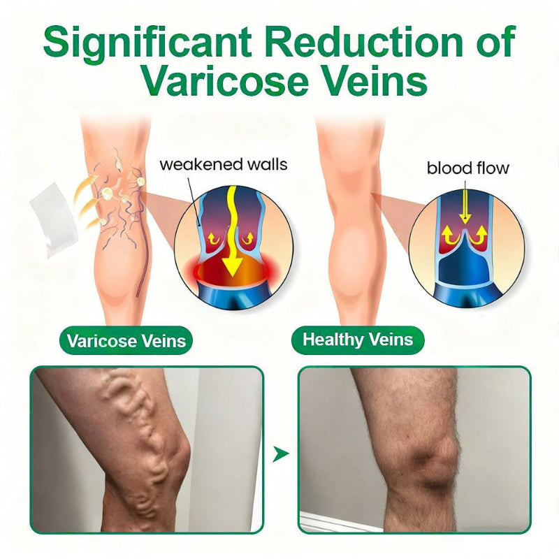 Varicose Vein Relief Microneedle Patch