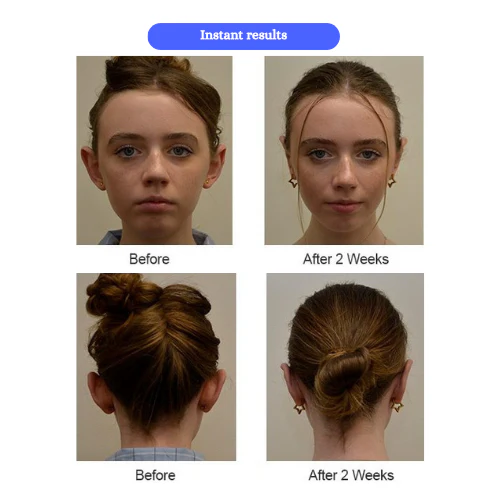 Ear Correctors