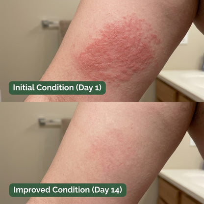 Antifungal Cleansing Soap for Skin Folds