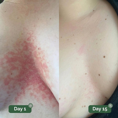 Antifungal Cleansing Soap for Skin Folds