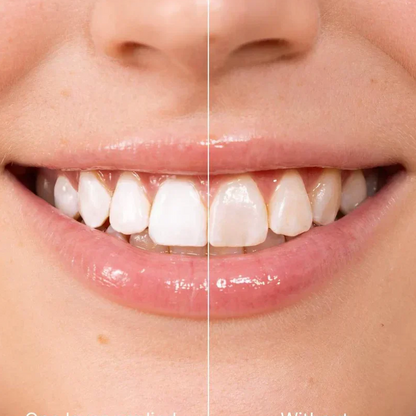 Whitening Strips – Fast Smile Boost